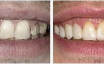 Fluoride and pollution